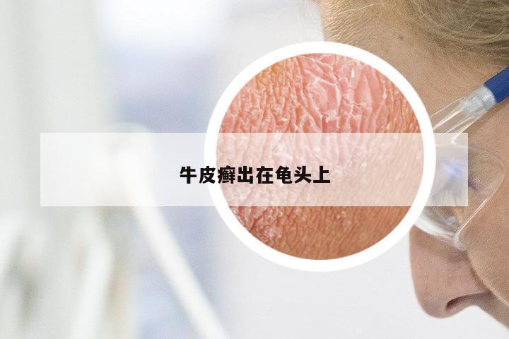牛皮癣出在龟头上