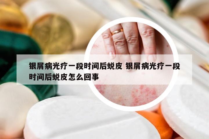 银屑病光疗一段时间后蜕皮 银屑病光疗一段时间后蜕皮怎么回事