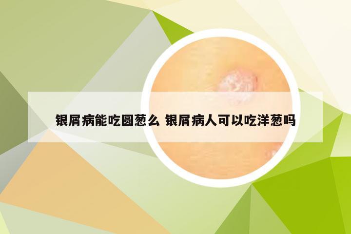 银屑病能吃圆葱么 银屑病人可以吃洋葱吗