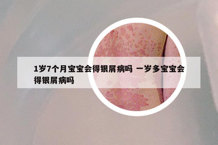 1岁7个月宝宝会得银屑病吗 一岁多宝宝会得银屑病吗