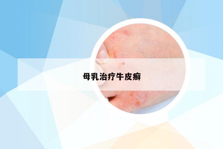 母乳治疗牛皮癣