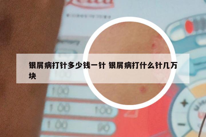 银屑病打针多少钱一针 银屑病打什么针几万块