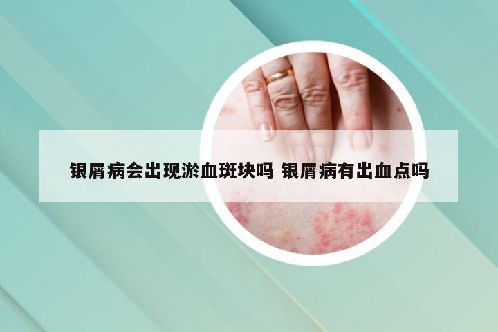 银屑病会出现淤血斑块吗 银屑病有出血点吗