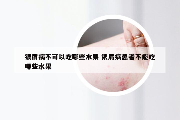 银屑病不可以吃哪些水果 银屑病患者不能吃哪些水果