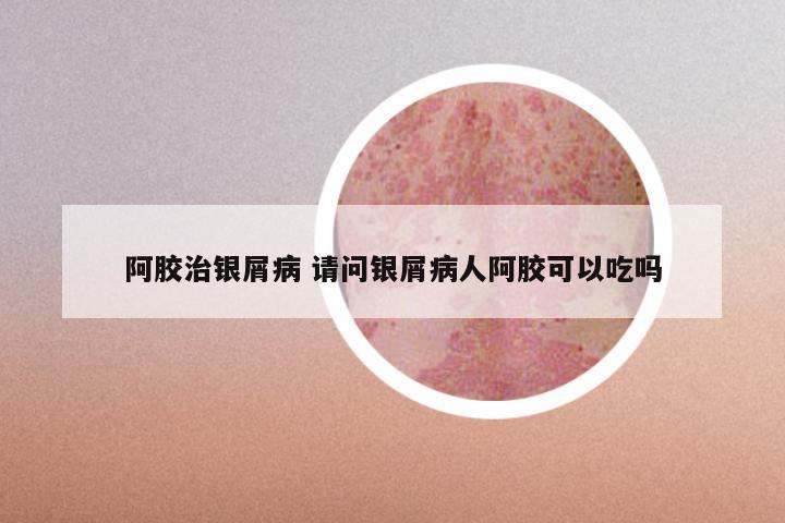 阿胶治银屑病 请问银屑病人阿胶可以吃吗