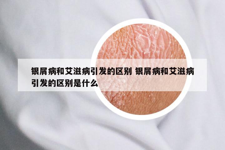 银屑病和艾滋病引发的区别 银屑病和艾滋病引发的区别是什么