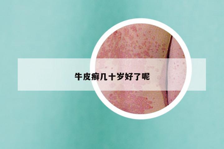 牛皮癣几十岁好了呢