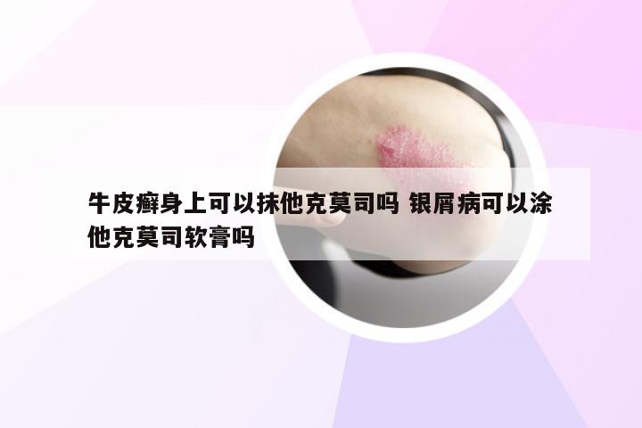 牛皮癣身上可以抹他克莫司吗 银屑病可以涂他克莫司软膏吗