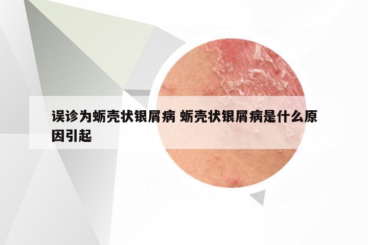 误诊为蛎壳状银屑病 蛎壳状银屑病是什么原因引起
