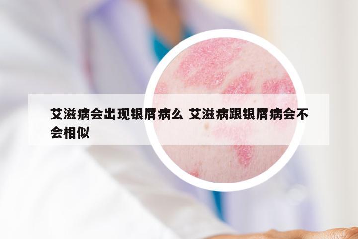 艾滋病会出现银屑病么 艾滋病跟银屑病会不会相似