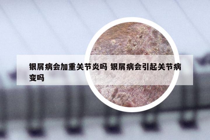 银屑病会加重关节炎吗 银屑病会引起关节病变吗