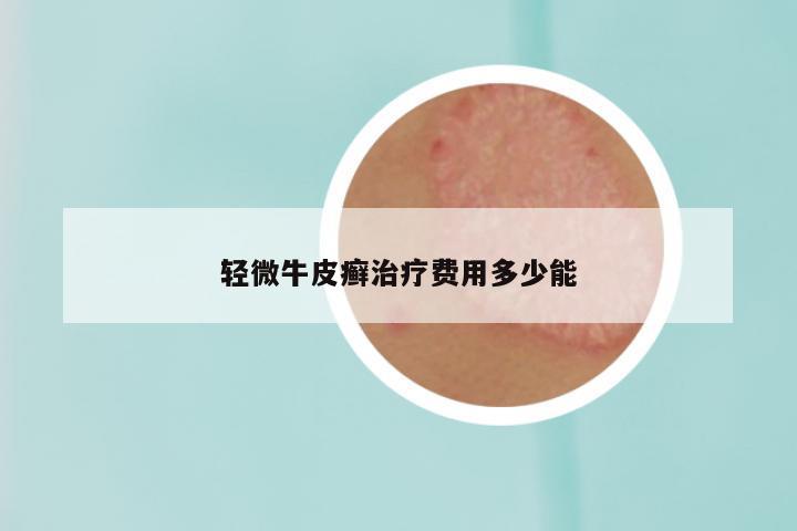 轻微牛皮癣治疗费用多少能