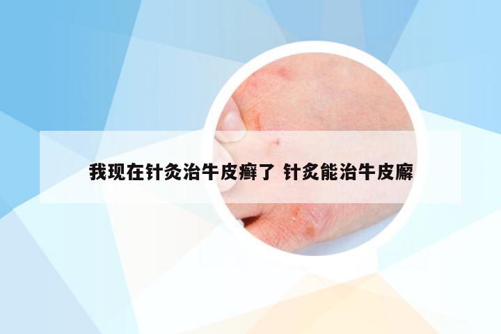 我现在针灸治牛皮癣了 针炙能治牛皮廨