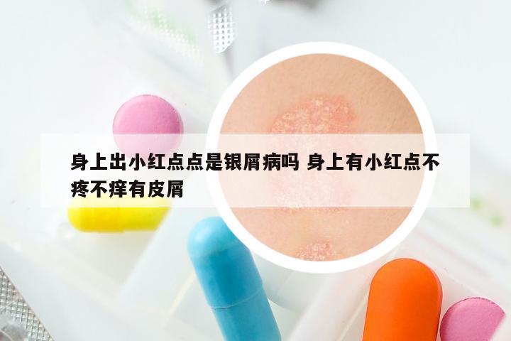 身上出小红点点是银屑病吗 身上有小红点不疼不痒有皮屑