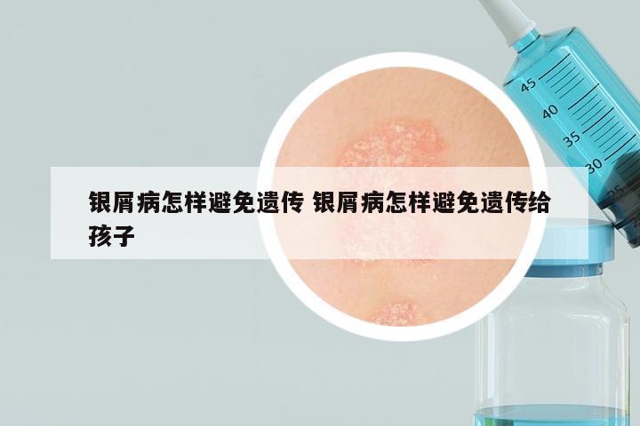 银屑病怎样避免遗传 银屑病怎样避免遗传给孩子