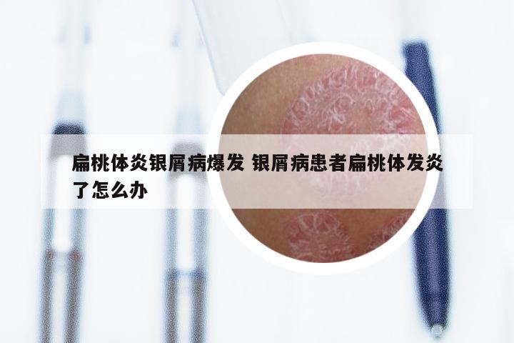 扁桃体炎银屑病爆发 银屑病患者扁桃体发炎了怎么办