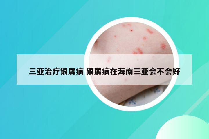 三亚治疗银屑病 银屑病在海南三亚会不会好
