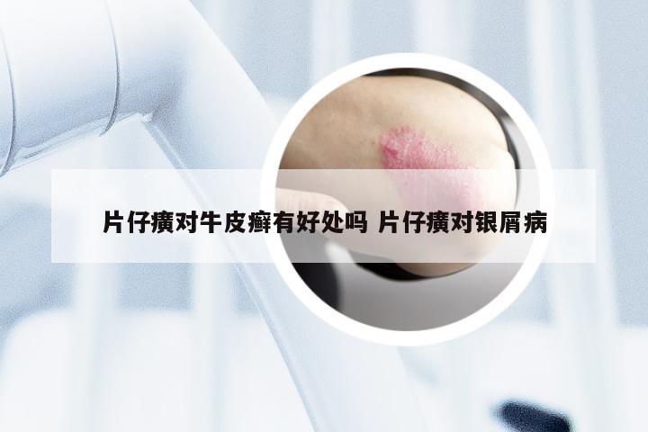 片仔癀对牛皮癣有好处吗 片仔癀对银屑病