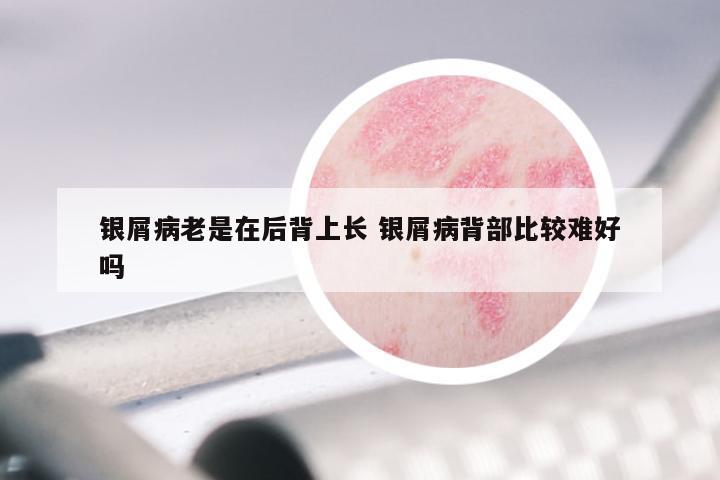 银屑病老是在后背上长 银屑病背部比较难好吗