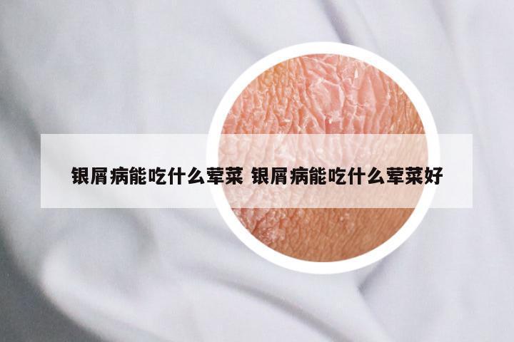 银屑病能吃什么荤菜 银屑病能吃什么荤菜好