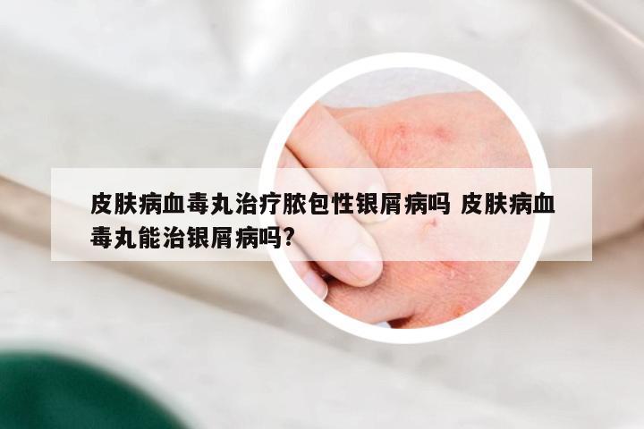 皮肤病血毒丸治疗脓包性银屑病吗 皮肤病血毒丸能治银屑病吗?