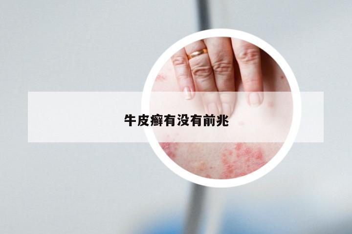 牛皮癣有没有前兆
