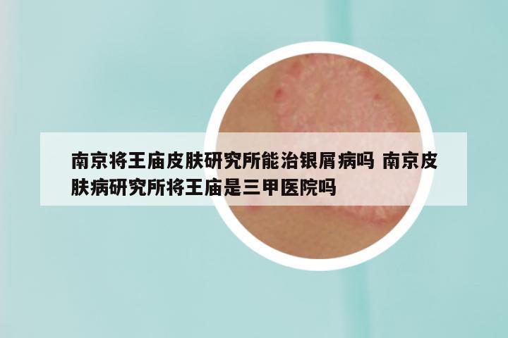 南京将王庙皮肤研究所能治银屑病吗 南京皮肤病研究所将王庙是三甲医院吗
