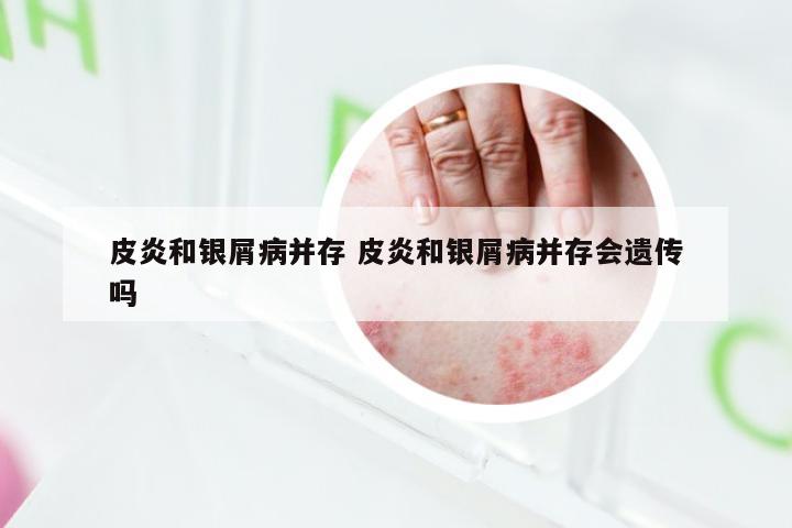 皮炎和银屑病并存 皮炎和银屑病并存会遗传吗