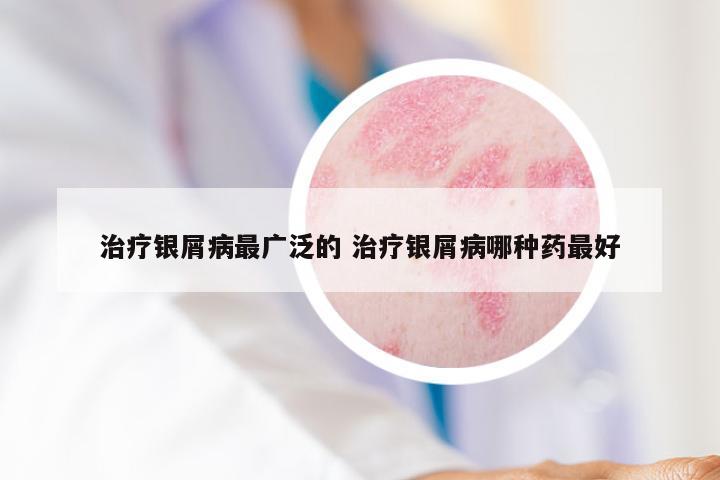 治疗银屑病最广泛的 治疗银屑病哪种药最好
