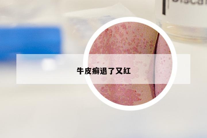 牛皮癣退了又红