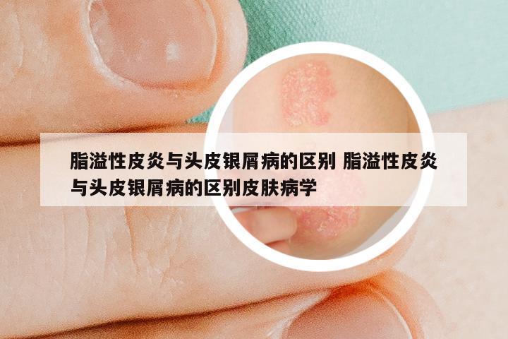 脂溢性皮炎与头皮银屑病的区别 脂溢性皮炎与头皮银屑病的区别皮肤病学