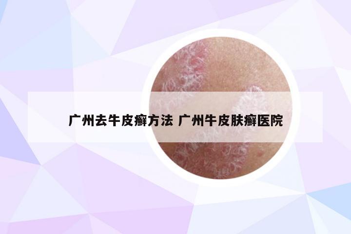 广州去牛皮癣方法 广州牛皮肤癣医院