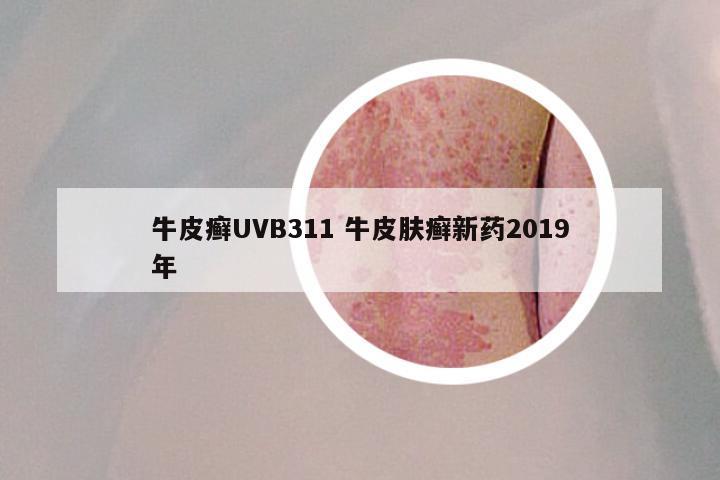 牛皮癣UVB311 牛皮肤癣新药2019年