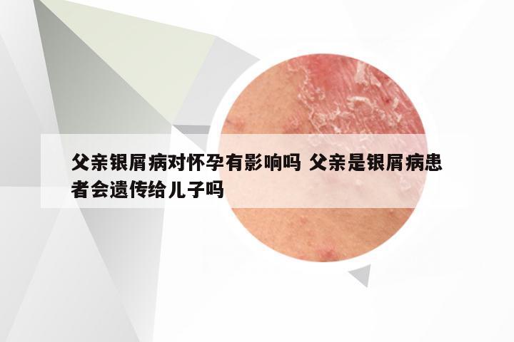 父亲银屑病对怀孕有影响吗 父亲是银屑病患者会遗传给儿子吗