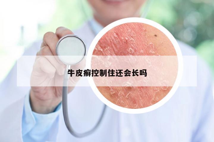 牛皮癣控制住还会长吗