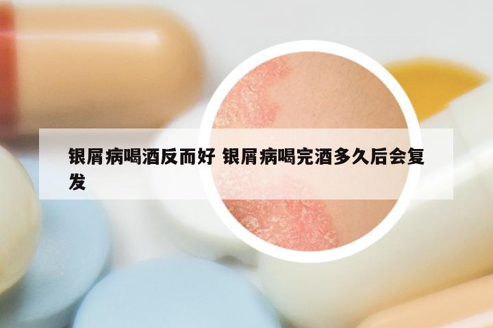 银屑病喝酒反而好 银屑病喝完酒多久后会复发