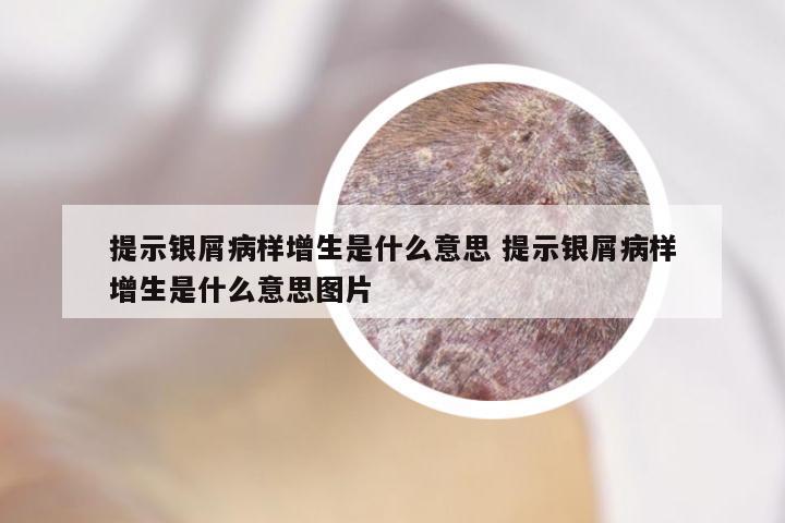 提示银屑病样增生是什么意思 提示银屑病样增生是什么意思图片