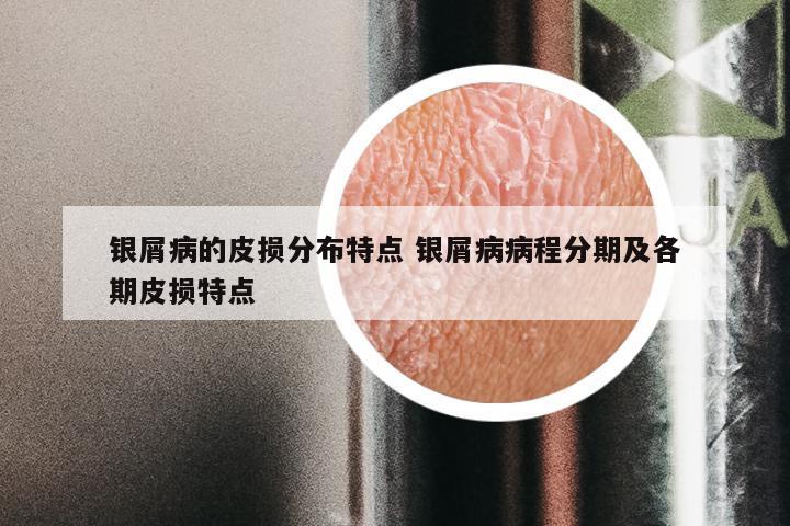 银屑病的皮损分布特点 银屑病病程分期及各期皮损特点