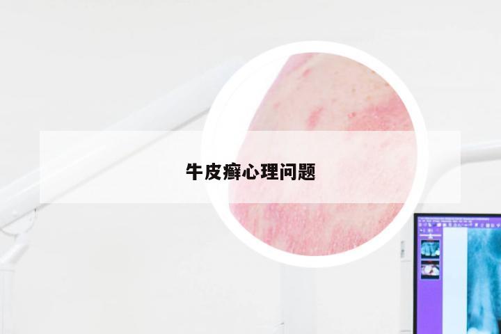 牛皮癣心理问题