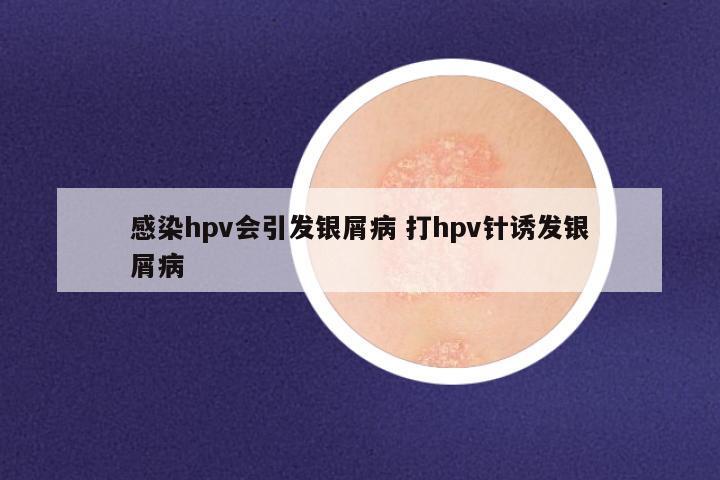 感染hpv会引发银屑病 打hpv针诱发银屑病