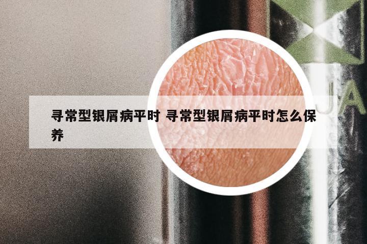 寻常型银屑病平时 寻常型银屑病平时怎么保养