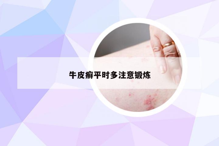 牛皮癣平时多注意锻炼