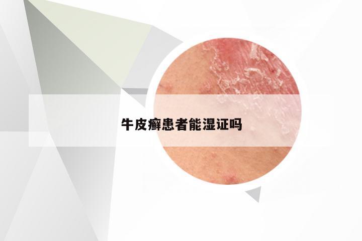 牛皮癣患者能湿证吗