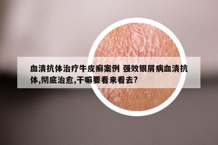 血清抗体治疗牛皮癣案例 强效银屑病血清抗体,彻底治愈,干嘛要看来看去?