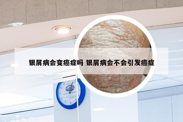 银屑病会变癌症吗 银屑病会不会引发癌症