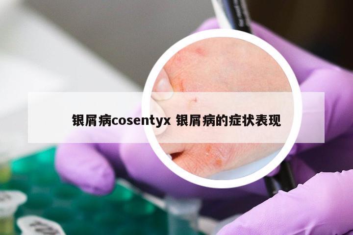 银屑病cosentyx 银屑病的症状表现