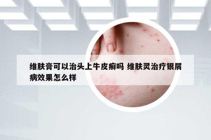 维肤膏可以治头上牛皮癣吗 维肤灵治疗银屑病效果怎么样