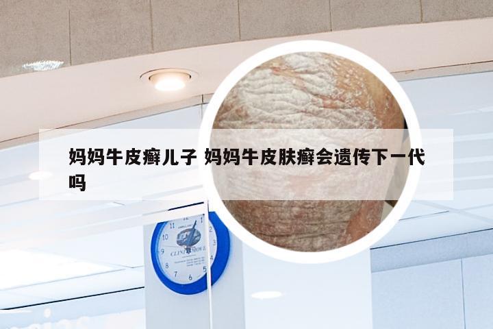妈妈牛皮癣儿子 妈妈牛皮肤癣会遗传下一代吗