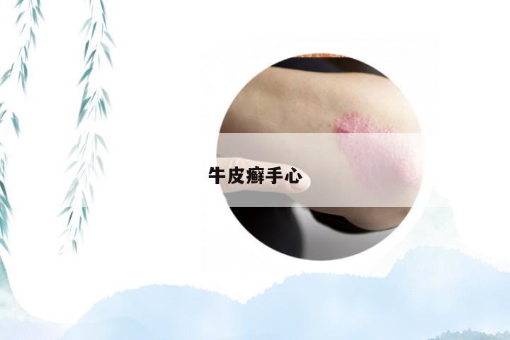 牛皮癣手心