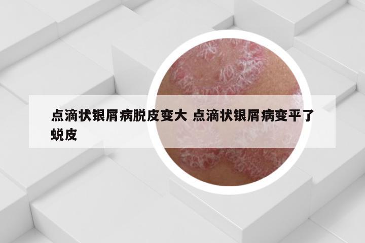 点滴状银屑病脱皮变大 点滴状银屑病变平了蜕皮